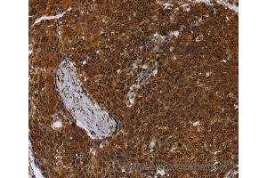 Immunohistochemistry of Human cervical cancer using MCHR1 Polyclonal Antibody at dilution of 1:30