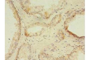 Immunohistochemistry of paraffin-embedded human prostate cancer using ABIN7176347 at dilution of 1:100 (ZNF501 anticorps  (AA 6-305))