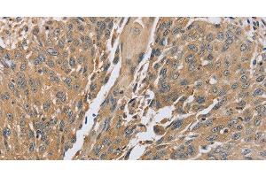 Immunohistochemistry of paraffin-embedded Human lung cancer using PTPN12 Polyclonal Antibody at dilution of 1:45 (PTPN12 anticorps)
