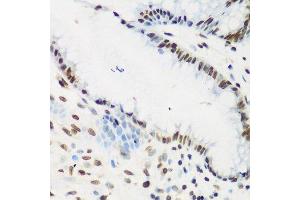Immunohistochemistry of paraffin-embedded human stomach cancer using KLF4 antibody.