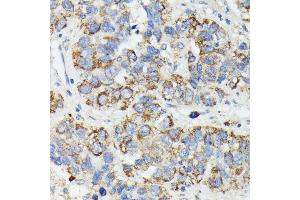 Immunohistochemistry of paraffin-embedded human liver cancer using MT-CYB antibody (ABIN7268595) at dilution of 1:100 (40x lens). (Cytochrome b anticorps)