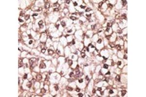 IHC analysis of FFPE human hepatocarcinoma tissue stained with the ABCB4 antibody (ABCB4 anticorps  (AA 624-654))