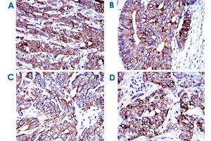 Immunohistochemical analysis of paraffin-embedded human cervical cancer (A) , human colon cancer (B) , human stomach cancer (C) and human bladder cancer (D) tissues using KRT19 monoclonal antibody, clone 4E8  with DAB staining. (Cytokeratin 19 anticorps)