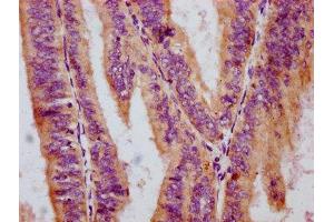 IHC image of ABIN7127737 diluted at 1:100 and staining in paraffin-embedded human endometrial cancer performed on a Leica BondTM system.