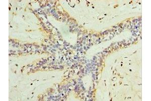 Immunohistochemistry of paraffin-embedded human breast cancer using ABIN7158005 at dilution of 1:100 (L3MBTL1 anticorps  (AA 513-752))