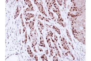 IHC-P Image Immunohistochemical analysis of paraffin-embedded Cal27 Xenograft, using MCM7, antibody at 1:100 dilution.