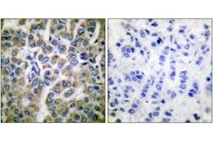 Immunohistochemistry analysis of paraffin-embedded human breast carcinoma tissue, using HSP10 Antibody. (HSPE1 anticorps  (AA 51-100))