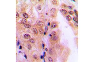 Immunohistochemical analysis of PPP2R5D staining in human lung cancer formalin fixed paraffin embedded tissue section.