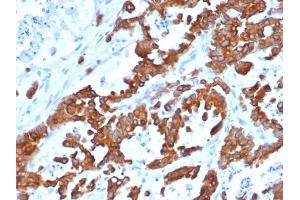 Formalin-fixed, paraffin-embedded human prostate carcinoma stained with EpCAM Recombinant Rabbit Monoclonal Antibody (EGP40/1555R).