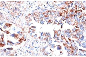Immunohistochemistry of paraffin-embedded Human lung cancer using TIM-3/HAVCR2 Polyclonal Antibody at dilution of 1:200 (40x lens). (TIM3 anticorps)