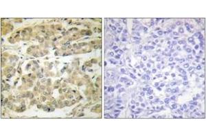 Immunohistochemistry analysis of paraffin-embedded human breast carcinoma, using 14-3-3 zeta (Phospho-Ser58) Antibody. (14-3-3 zeta anticorps  (pSer58))