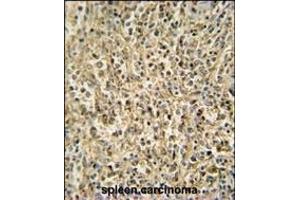 RNT2 antibody (N-term) (ABIN654720 and ABIN2844409) immunohistochemistry analysis in formalin fixed and paraffin embedded human spleen carcinoma followed by peroxidase conjugation of the secondary antibody and DAB staining. (RNASET2 anticorps  (N-Term))