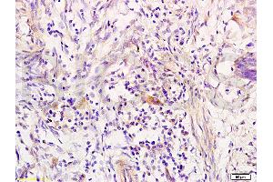 Formalin-fixed and paraffin embedded human colon carcinoma tissue labeled with Anti-RRM1 Polyclonal Antibody, Unconjugated (ABIN731543) at 1:200 followed by conjugation to the secondary antibody, (SP-0023), and DAB staining (RRM1 anticorps  (AA 733-778))