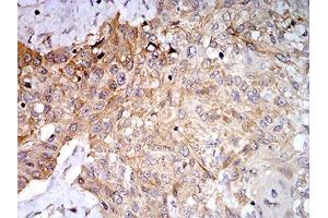 Immunohistochemical analysis of paraffin-embedded esophageal cancer tissues using PLD2 mouse mAb with DAB staining.