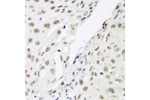 Immunohistochemistry of paraffin-embedded human lung cancer using CBX3 antibody.