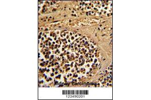 Formalin-fixed and paraffin-embedded human kidney carcinoma reacted with ESRRA Antibody , which was peroxidase-conjugated to the secondary antibody, followed by DAB staining. (ESRRA anticorps  (AA 131-159))