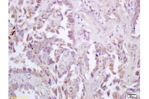 Formalin-fixed and paraffin embedded human lung carcinoma labeled with Rabbit Anti ChRM3/Acetylcholine receptor(M3) Polyclonal Antibody, Unconjugated (ABIN674484) at 1:200 followed by conjugation to the secondary antibody and DAB staining