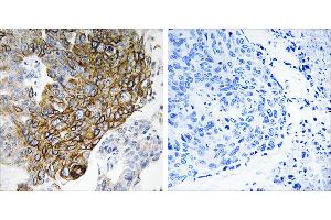Peptide - +Immunohistochemistry analysis of paraffin-embedded human lung carcinoma tissue using GJA3 antibody. (GJA3 anticorps  (Internal Region))