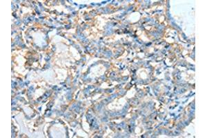The image on the left is immunohistochemistry of paraffin-embedded Human thyroid cancer tissue using ABIN7128285(AGBL3 Antibody) at dilution 1/45, on the right is treated with fusion protein. (AGBL3 anticorps)