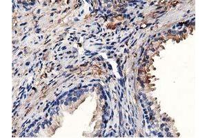 Immunohistochemical staining of paraffin-embedded Adenocarcinoma of Human colon tissue using anti-MICAL1 mouse monoclonal antibody. (MICAL1 anticorps)