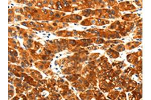 The image on the left is immunohistochemistry of paraffin-embedded Human liver cancer tissue using ABIN7191931(PLXNA3 Antibody) at dilution 1/25, on the right is treated with synthetic peptide. (Plexin A3 anticorps)
