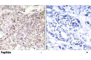 Immunohistochemistry analysis of paraffin-embedded human breast carcinoma tissue using GPRIN3 polyclonal antibody .