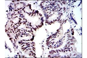Immunohistochemical analysis of paraffin-embedded colon cancer tissues using MCM2 mouse mAb with DAB staining.