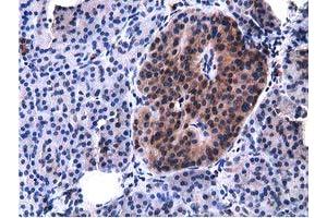 Immunohistochemical staining of paraffin-embedded Carcinoma of Human lung tissue using anti-VWA5A mouse monoclonal antibody. (VWA5A anticorps)