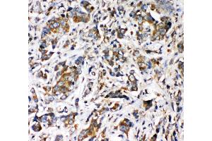 Anti-VRL1 antibody, IHC(P) IHC(P): Human Intestinal Cancer Tissue (TRPV2 anticorps  (N-Term))
