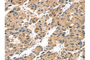 The image on the left is immunohistochemistry of paraffin-embedded Human liver cancer tissue using ABIN7192934(TRPV5 Antibody) at dilution 1/25, on the right is treated with synthetic peptide.