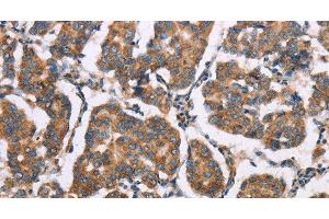 Immunohistochemistry of paraffin-embedded Human breast cancer tissue using ELP3 Polyclonal Antibody at dilution of 1:35 (ELP3/KAT9 anticorps)