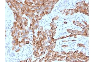 Formalin-fixed, paraffin-embedded human Lung Carcinoma stained with Cytokeratin-7 Mouse Monoclonal Antibody (KRT7/2200). (Cytokeratin 7 anticorps)
