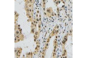 Immunohistochemical analysis of TBX1 staining in human lung cancer formalin fixed paraffin embedded tissue section.