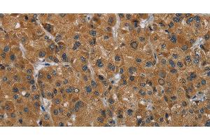 Immunohistochemistry of paraffin-embedded Human liver cancer using HSD3B7 Polyclonal Antibody at dilution of 1:40 (HSD3B7 anticorps)
