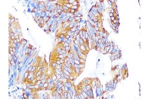 Immunohistochemistry of paraffin-embedded human colon carcinoma using EBP1/PG4 Rabbit mAb (ABIN7269550) at dilution of 1:100 (40x lens).