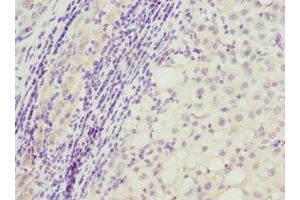 Immunohistochemistry of paraffin-embedded human liver cancer using ABIN7162470 at dilution of 1:100 (TP53AIP1 anticorps  (AA 1-108))