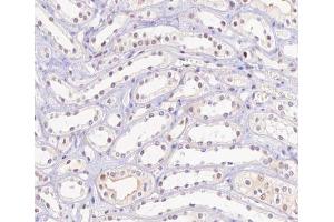 ABIN6267506 at 1/100 staining human kidney carcinoma tissue sections by IHC-P. (HNF4A anticorps  (pSer313))