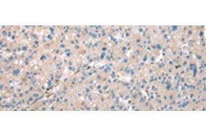 Immunohistochemistry of paraffin-embedded Human liver cancer tissue using DCAF7 Polyclonal Antibody at dilution of 1:30(x200) (DCAF7 anticorps)