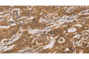 Immunohistochemistry of paraffin-embedded Human gastric cancer tissue using CYP17A1 Polyclonal Antibody at dilution 1:30 (CYP17A1 anticorps)