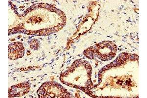 Immunohistochemistry of paraffin-embedded human prostate cancer using ABIN7154428 at dilution of 1:100