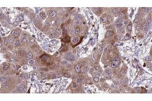 ABIN6276632 at 1/100 staining Human liver cancer tissue by IHC-P. (CD236/GYPC anticorps  (Internal Region))