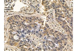 DYRK3 Mouse Monoclonal Antibody at 1/100 staining human lung cancer and adjacent non-tumor tissue by IHC-P. (DYRK3 anticorps  (Internal Region))