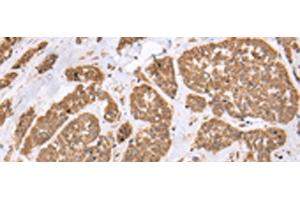 Immunohistochemistry of paraffin-embedded Human esophagus cancer tissue using E2F5 Polyclonal Antibody at dilution of 1:25(x200)