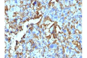 Formalin-fixed, paraffin-embedded human Histiocytoma stained with HLA-DR Monoclonal Antibody (LN-3 + HLA-DRB/1067). (HLA-DRB1 anticorps)
