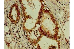 IHC image of ABIN7143827 diluted at 1:200 and staining in paraffin-embedded human breast cancer performed on a Leica BondTM system.