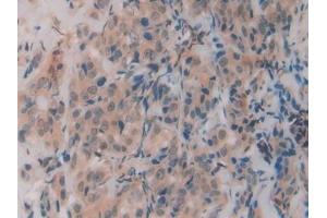 Detection of RSPO1 in Human Breast cancer Tissue using Polyclonal Antibody to R-Spondin 1 (RSPO1)