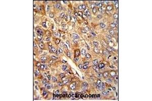 Formalin-fixed and paraffin-embedded human hepatocarcinoma with FTH1 Antibody (C-term), which was peroxidase-conjugated to the secondary antibody, followed by DAB staining.