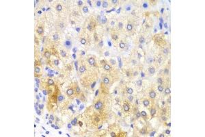 Immunohistochemistry of paraffin-embedded human liver cancer using FASN Antibody.