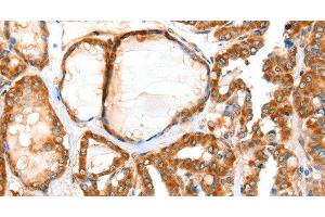 Immunohistochemistry of paraffin-embedded Human thyroid cancer tissue using ACOX1 Polyclonal Antibody at dilution 1:40 (ACOX1 anticorps)