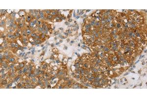 Immunohistochemistry of paraffin-embedded Human breast cancer using TPD54 Polyclonal Antibody at dilution of 1:35 (TPD52L2 anticorps)